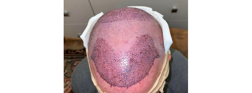 Hair Transplants Los Angeles